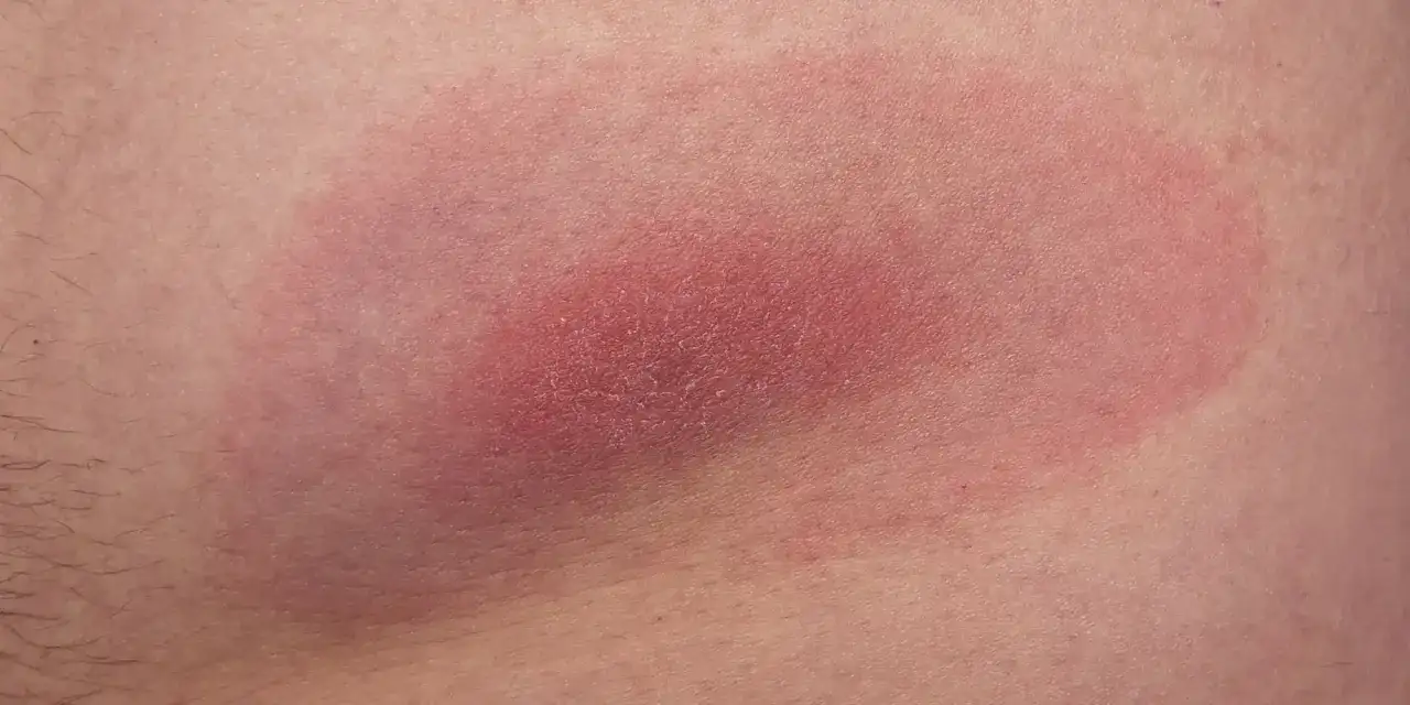 Rumieniowa plama na skórze, przypominająca ślad po kleszczu, z zaczerwienieniem i lekkim łuszczeniem.